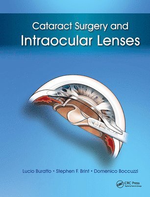 bokomslag Cataract Surgery and Intraocular Lenses