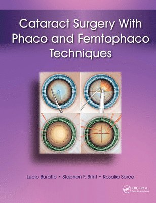 Cataract Surgery With Phaco and Femtophaco Techniques 1