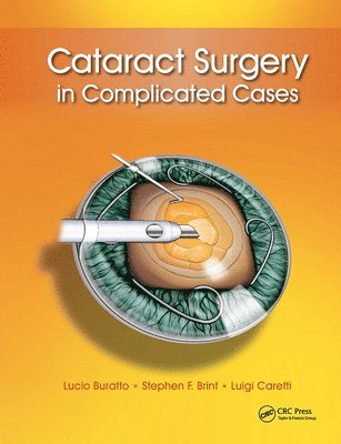 bokomslag Cataract Surgery in Complicated Cases