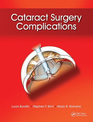 bokomslag Cataract Surgery Complications