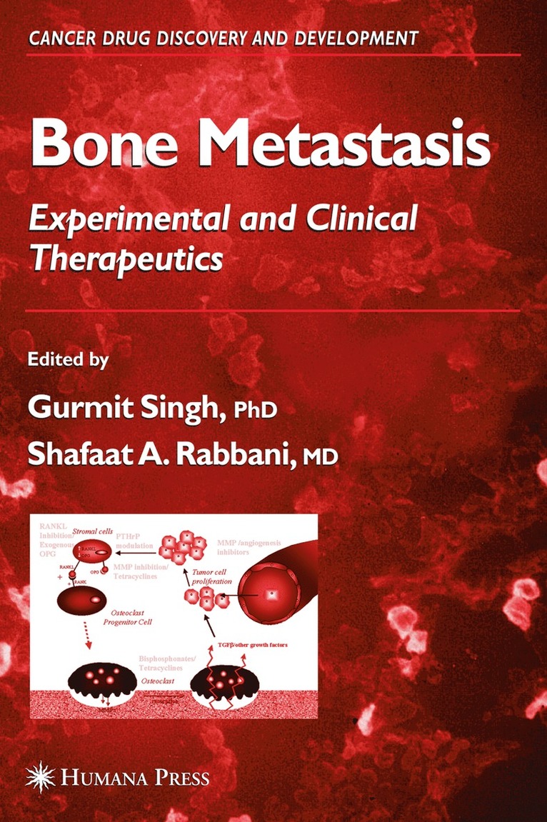 Bone Metastasis 1