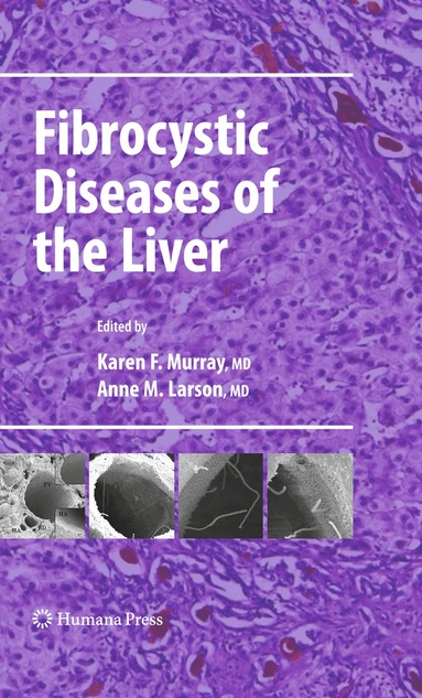 Karen F. Murray, Anne M. Larson - Fibrocystic Diseases of the Liver, Häftad