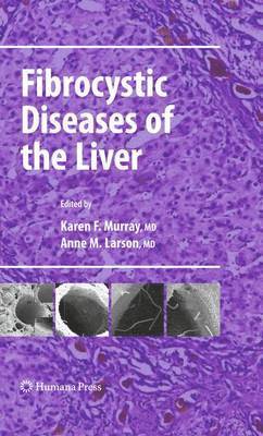 Karen F. Murray, Anne M. Larson - Fibrocystic Diseases of the Liver, Häftad