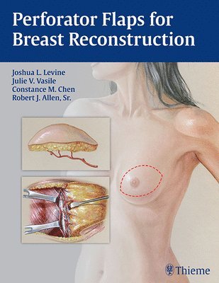 Perforator Flaps for Breast Reconstruction 1