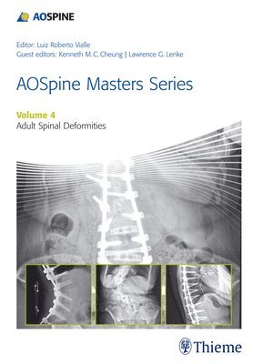 AOSpine Master Series, Vol. 4: Adult Spinal Deformities 1