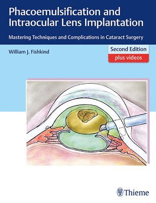 Phacoemulsification and Intraocular Lens Implantation 1