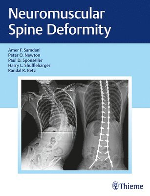 Neuromuscular Spine Deformity 1