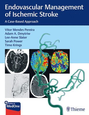 Endovascular Management of Ischemic Stroke 1