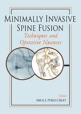 bokomslag Minimally Invasive Spine Fusion: Techniques and Operative Nuances
