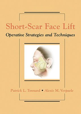 Short-Scar Face Lift 1