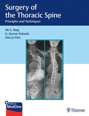 Surgery of the Thoracic Spine 1