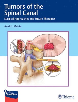 bokomslag Tumors of the Spinal Canal