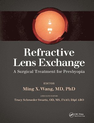Refractive Lens Exchange 1