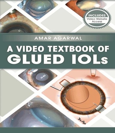 Amar Agarwal - Video Textbook of Glued IOLs, Häftad