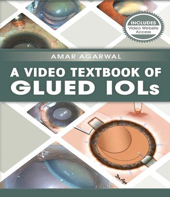 bokomslag A Video Textbook of Glued IOLs