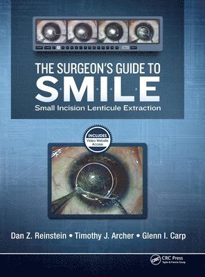 The Surgeon's Guide to SMILE 1