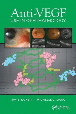 Anti-VEGF Use in Ophthalmology 1