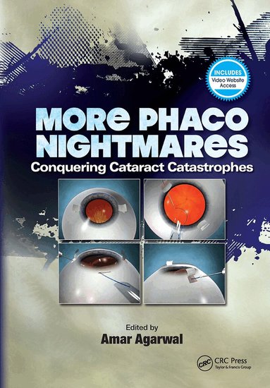 Amar Agarwal - More Phaco Nightmares, Inbunden
