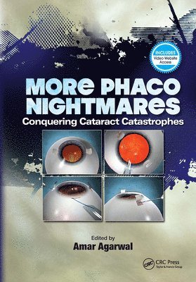 More Phaco Nightmares 1