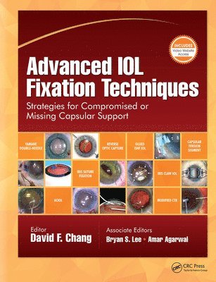 Advanced IOL Fixation Techniques