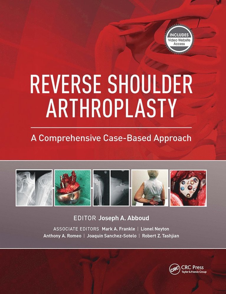 Joseph Abboud - Reverse Shoulder Arthroplasty, Inbunden