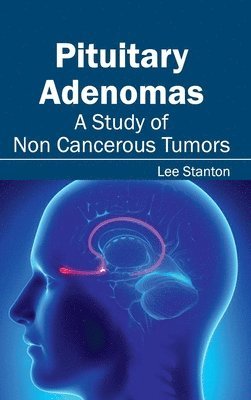 Pituitary Adenomas: A Study of Non Cancerous Tumors 1