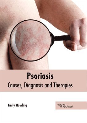 bokomslag Psoriasis: Causes, Diagnosis and Therapies