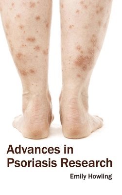 bokomslag Advances in Psoriasis Research