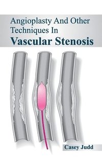 bokomslag Angioplasty and Other Techniques in Vascular Stenosis