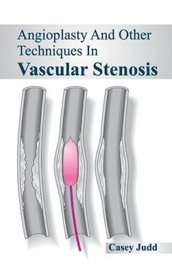 Angioplasty and Other Techniques in Vascular Stenosis 1