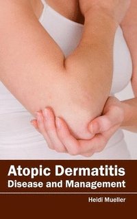 bokomslag Atopic Dermatitis: Disease and Management