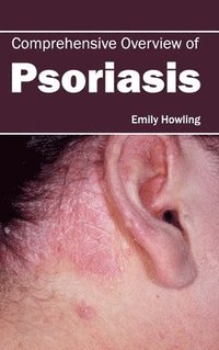 bokomslag Comprehensive Overview of Psoriasis