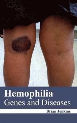 Brian Jenkins - Hemophilia: Genes and Diseases, Inbunden