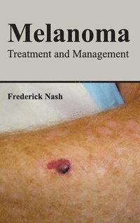 bokomslag Melanoma: Treatment and Management