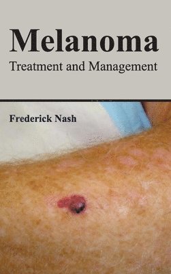 Frederick Nash - Melanoma: Treatment and Management, Inbunden
