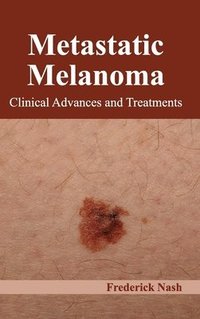bokomslag Metastatic Melanoma: Clinical Advances and Treatments