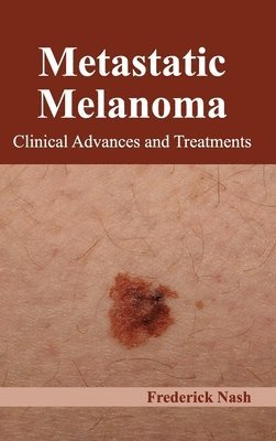 Frederick Nash - Metastatic Melanoma: Clinical Advances and Treatments, Inbunden