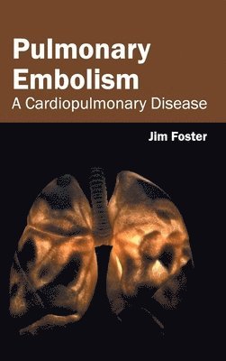 Jim Foster - Pulmonary Embolism: A Cardiopulmonary Disease, Inbunden