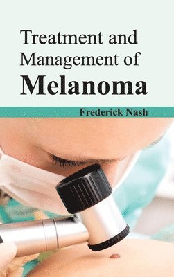 Frederick Nash - Treatment and Management of Melanoma, Inbunden