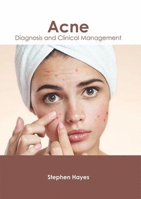 Stephen Hayes - Acne: Diagnosis and Clinical Management, Inbunden
