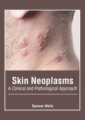 Spencer Wells - Skin Neoplasms: A Clinical and Pathological Approach, Inbunden