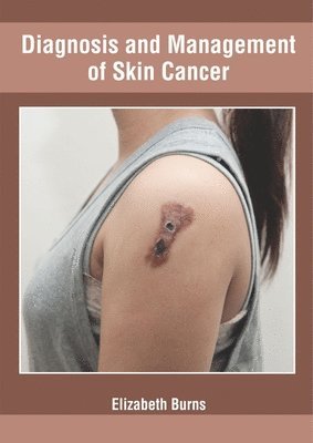 Elizabeth Burns - Diagnosis and Management of Skin Cancer, Inbunden