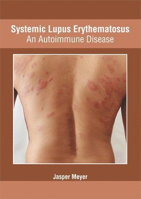 Systemic Lupus Erythematosus: An Autoimmune Disease 1