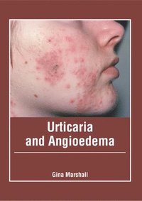 bokomslag Urticaria and Angioedema