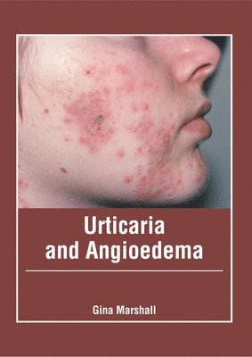 Gina Marshall - Urticaria and Angioedema, Inbunden