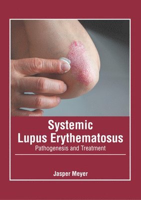 Systemic Lupus Erythematosus: Pathogenesis and Treatment 1