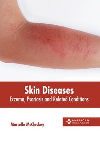 bokomslag Skin Diseases: Eczema, Psoriasis and Related Conditions