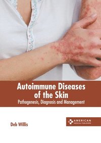 bokomslag Autoimmune Diseases of the Skin: Pathogenesis, Diagnosis and Management