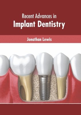 Jonathan Lewis - Recent Advances in Implant Dentistry, Inbunden
