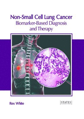 bokomslag Non-Small Cell Lung Cancer: Biomarker-Based Diagnosis and Therapy